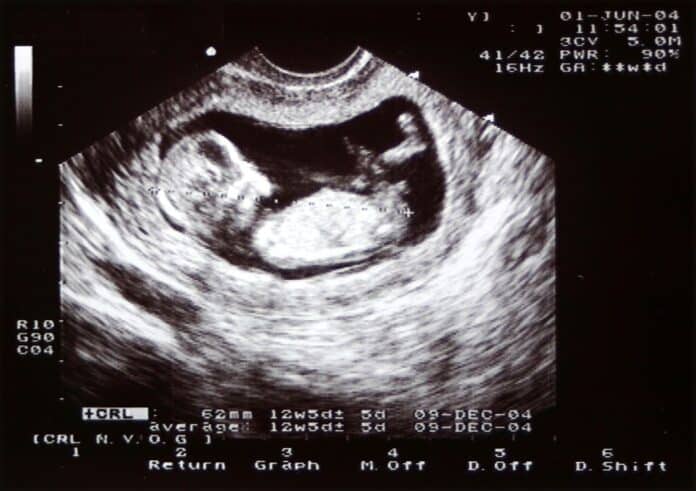 Sexe Du B b Echographie Gar on Ou Fille sexe-du-b-b-echographie-gar-on-ou-fille