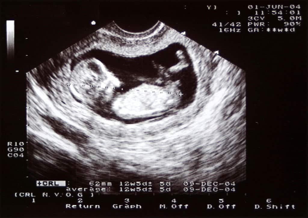 Sexe du bébé : Echographie Garçon ou Fille