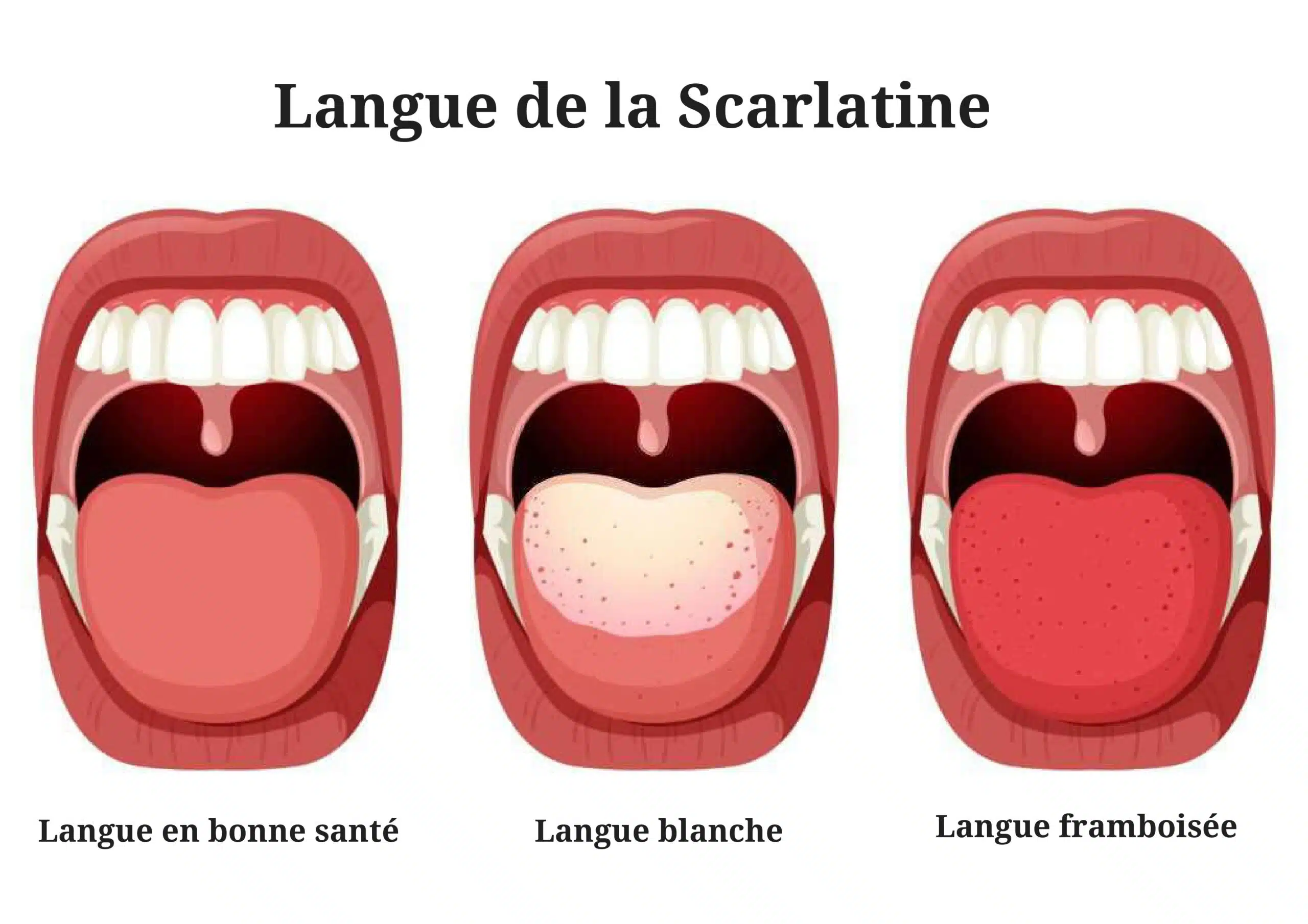 virus ou bactérie de la scarlatine