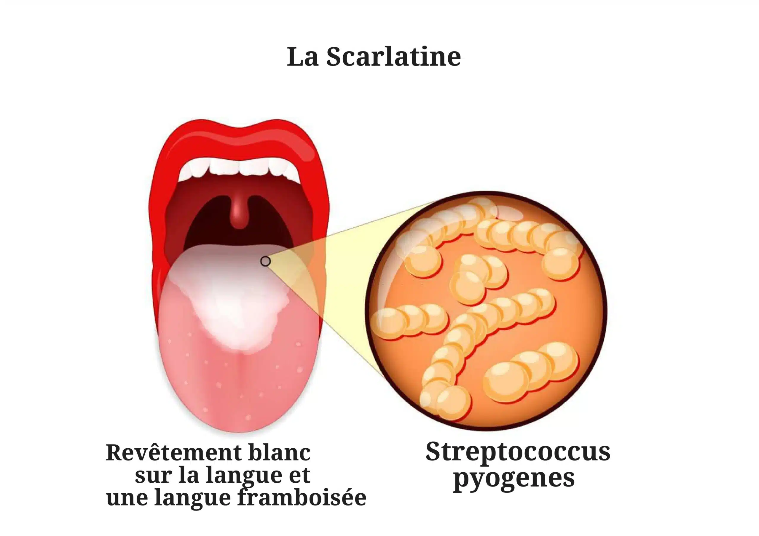 virus ou bactérie de la scarlatine